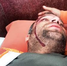 Journalist Injured After Hit By Pellets In Shopian During Clashes