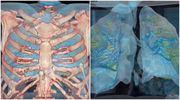 This 3D video shows how quickly coronavirus can attack a healthy person’s lungs