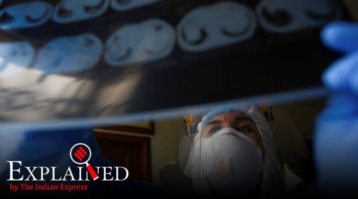 Explained: What is silent hypoxia, and why has it puzzled doctors?