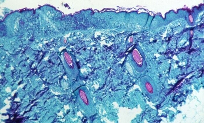 More than 700 monkeypox cases globally, 21 in US: public health agency