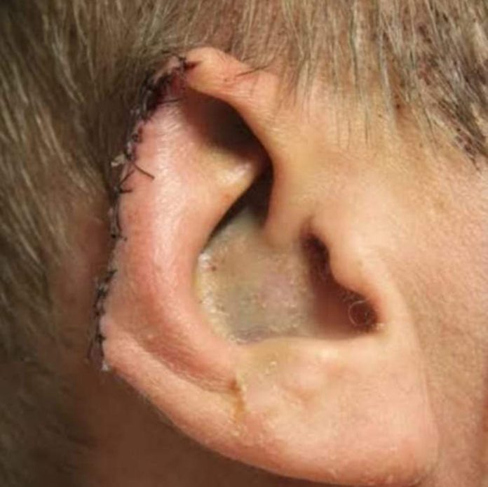 Teacher arrested in Pattan for biting off colleague’s ear